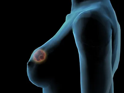 Рак молочной железы – симптомы, лечение, прогноз, операция в Москве