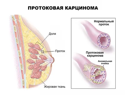 Протоковый рак молочной железы: симптомы, признаки, стадии, лечение, прогноз
