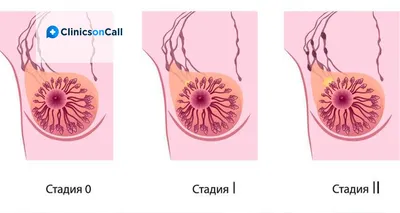 Стадии рака груди — ответы на вопросы - Clinics on Call