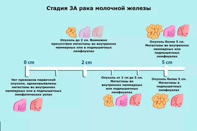 Рак груди 3 стадия, прогноз рака молочной железы 3 степени | Patient-mt.ru