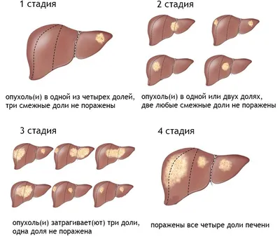 Рак молочных желез: методы и способы лечения онкологии молочных желез на  разных стадиях