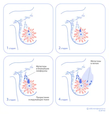 Онко Вики — Стадии рака молочной железы