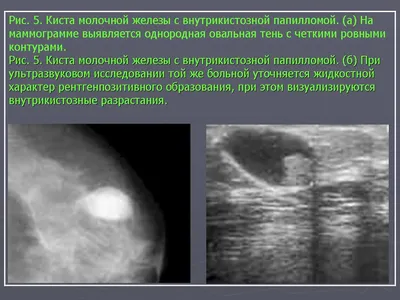 УЗИ при раке молочной железы