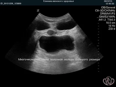 Рак молочной железы BI-RADS-5 | Радиография