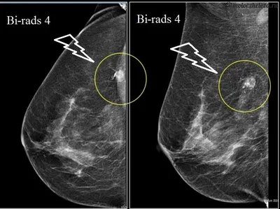 ⚕ Клинический случай: рак молочных желез - PULSE