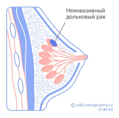 Октябрь - Всемирный месяц борьбы с раком молочной железы