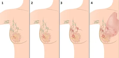 Рак молочной железы. | Реальный медик | Дзен