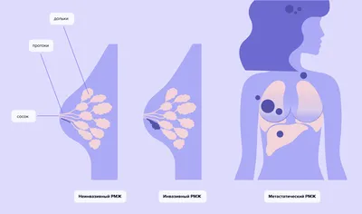 Ранняя стадия рака молочной железы — диагностика и лечение