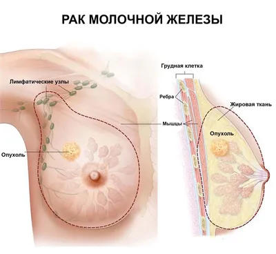 Диагностика рака молочной железы: виды, как проводить самодиагностику?