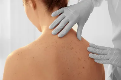 Как избежать возникновения рака кожи - Ева Арт