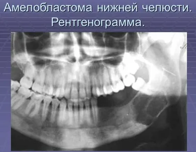 Рак полости рта - Вопрос онкологу - 03 Онлайн