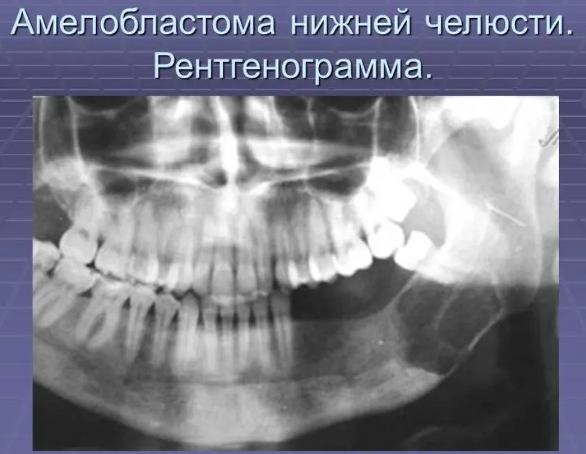 Миобластома. Амелобластома нижней челюсти рентгенограмма. Амелобластома нижней челюсти рентген. Амелобластома челюсти. Амелобластома верхней челюсти рентген.