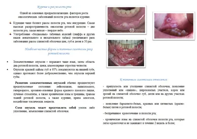 Кандидоз полости рта: симптомы, особенности, диагностика и лечение  заболевания - блог «ДИНАСТИЯ»