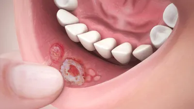 Рак полости рта: фото начальной стадии, симптомы, лечение и прогноз -  Belhope.ru