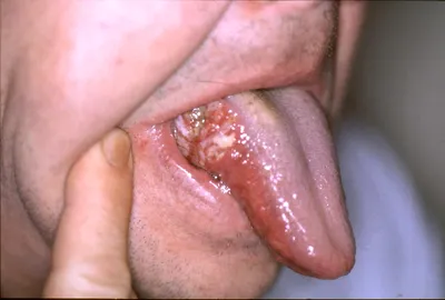 Рак языка и полости рта: причины, симптомы и лечение в статье онколога Опря  А. Н.