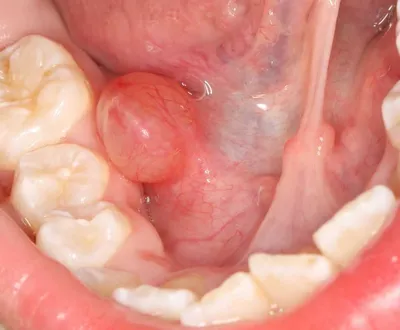 Злокачественные опухоли полости рта — Википедия