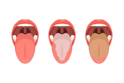 Рак полости рта: симптомы рака слизистой рта, как выглядит опухоль ротовой  полости, фото | Клиники «Евроонко»