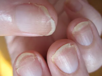 Рак можно выявить по состоянию ногтей | InterCOR - о человеке, здоровье,  питании и стиле жизни | Дзен