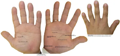 Как определить рак легких по пальцам рук - Страсти