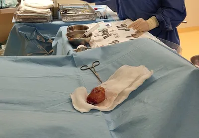 Челябинские кардиохирурги удалили женщине огромную опухоль сердца