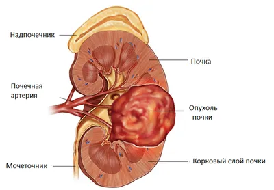 Рак сердца - online presentation