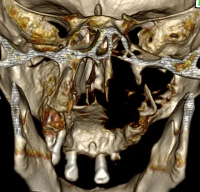 3.2. дефект верхней челюсти справа - Микрохирургия лица