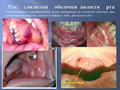 Факторы риска развития онкологических заболеваний в полости рта - 14-я  центральная районная поликлиника