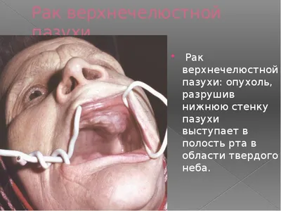 Рак челюсти - причины, стадии, симптомы, признаки, диагностика, лечение,  прогноз