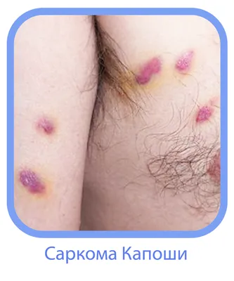 Как определить рак кожи: симптомы и признаки возможной онкологии кожи