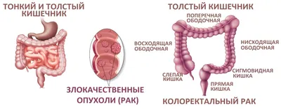 Меланома - рак кожи