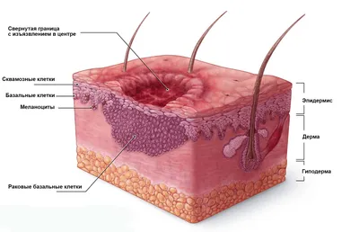 Как отличить рака кожи от меланомы — фото с примерами и рекомендации  онколога - 14 февраля 2019 - 59.ru