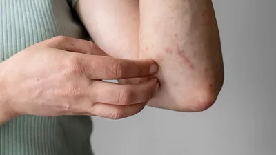 Раздражение на коже у взрослых: симптомы, причины, лечение, профилактика в  домашних условиях