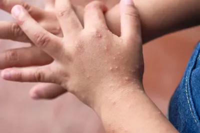Атопический дерматит: правила ухода за кожей