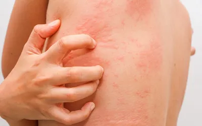 Каковы причины аллергического дерматита век? «Ochkov.net»