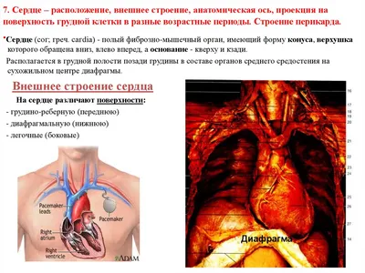 Инфаркт миокарда: как выглядит, что значит инфаркт сердца