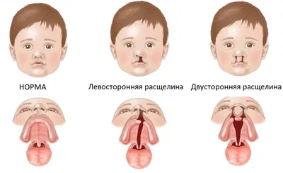 Пластика врожденных расщелин верхней губы и нёба — «Звезда Милосердия»