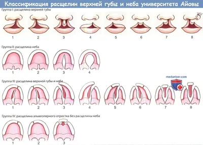 Почему фонд собирает деньги на операции детей с расщелиной губы и неба,  если их делают по полису ОМС? | Благотворительный фонд «Звезда Милосердия»  / Информационный портал «Путь к улыбке» | Дзен