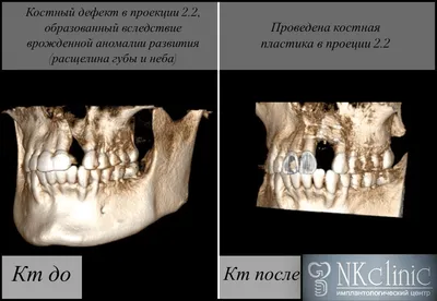 Классификация расщелины неба и верхней губы у ребенка