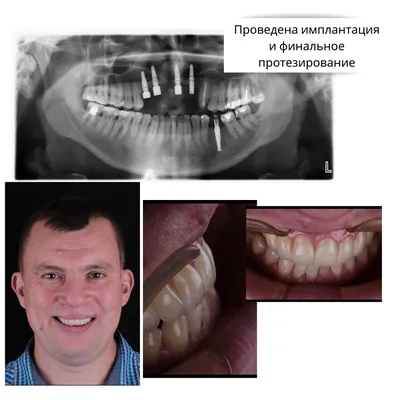 Диагностическое значение анализа матриксных металлопротеиназ у детей с расщелиной  губы и неба - DENTALMAGAZINE.RU