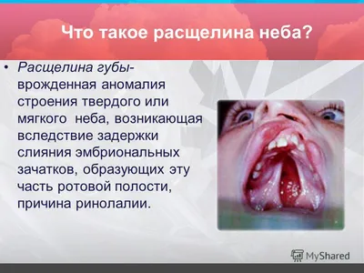 Детская челюстно - лицевая хирургия - #Врожденная #расщелина #твердого и # мягкого #неба, после #ураностафилопластики | Facebook