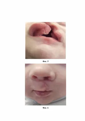 Коррекция типичной деформации верхней губы и носа после врождённых расщелин  губы и нёба. Операцию проводил пластический и члюстно-лицевой хирург Олег  Яцкевич