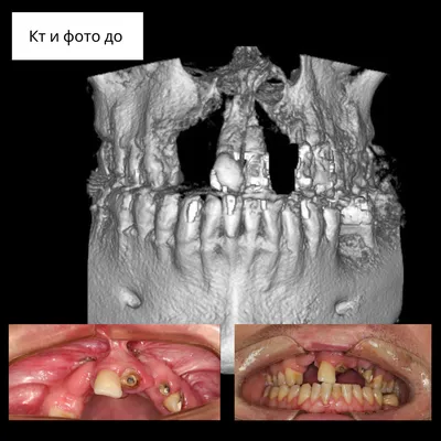 Имплантация зубов при врожденной расщелине губы | НК Клиник