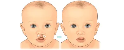 Предхирургическая ортодонтическое лечение детей с расщелиной губы и неба