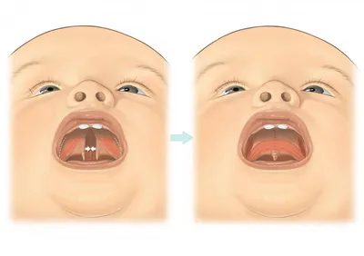 Пример работы: Реабилитация зубного ряда посредством ортопедического  лечения с опорой на имплантаты
