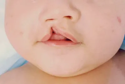 Классификация расщелины неба и верхней губы у ребенка