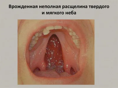 Хирургическое лечение расщелины неба в шесть месяцев снизило риск нарушений  речи в пять лет. Это вывод рандомизированного исследования