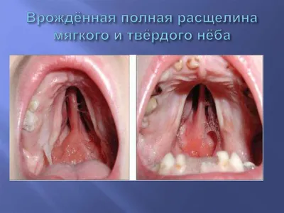 Структура стоматологической заболеваемости у детей с врожденными пороками  развития зубочелюстной системы