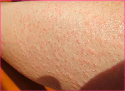 Раздражения кожи груди причины и следствия