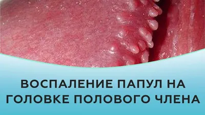 Высыпания на головке полового органа: причины, симптомы и методы лечения