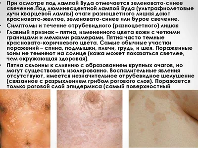 dr_kotlobai - Замечали подобные пятна у себя или у окружающих?😨 Это  разноцветный или отрубевидный лишай🎨. Но не пугайтесь страшного названия,  заболевание не заразно. Эти пятна возникают в результате нарушения в  соотношении микрофлоры